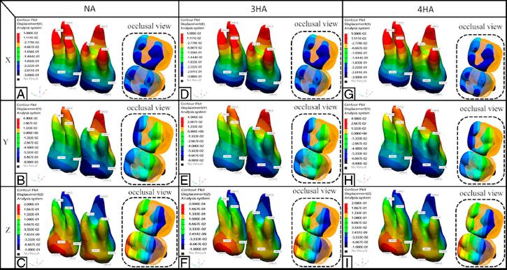 Three-dimensional displacement tendency of the maxillary first and second molars in high and flat trimline aligner (HTLA) models. No attachment: (A) Displacement along the x-axis; (B) Displacement along the y-axis; (C) Displacement along the z-axis; 3 mm horizontal rectangular attachment: (D) Displacement along the x-axis; (E) Displacement along the y-axis; (F) Displacement along the z-axis; 3 mm horizontal rectangular attachment: (G) Displacement along the x-axis; (H) Displacement along the y-axis; (I) Displacement along the z-axis.