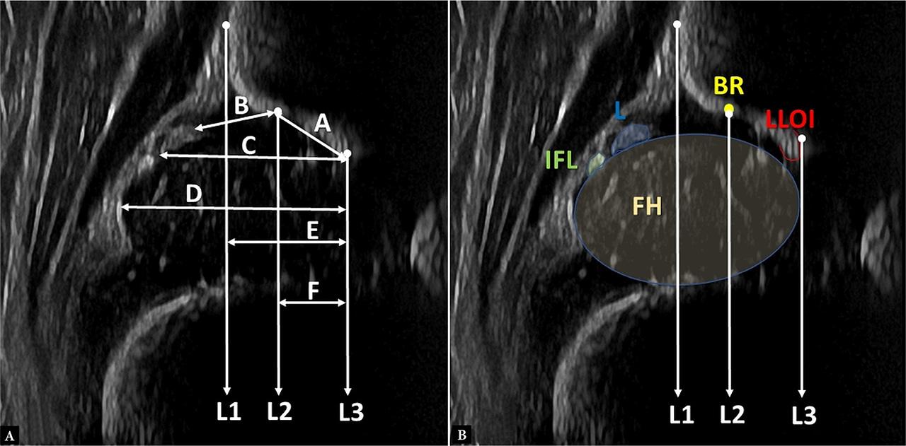 A. Demonstration of the lines and measurements which were evaluated. B. Schematic representation of major anatomical landmarks. FH – femoral head, L – labrum, IFL – ischiofemoral ligament, BR – bony rim; LLOI – lower limb of the os ilium