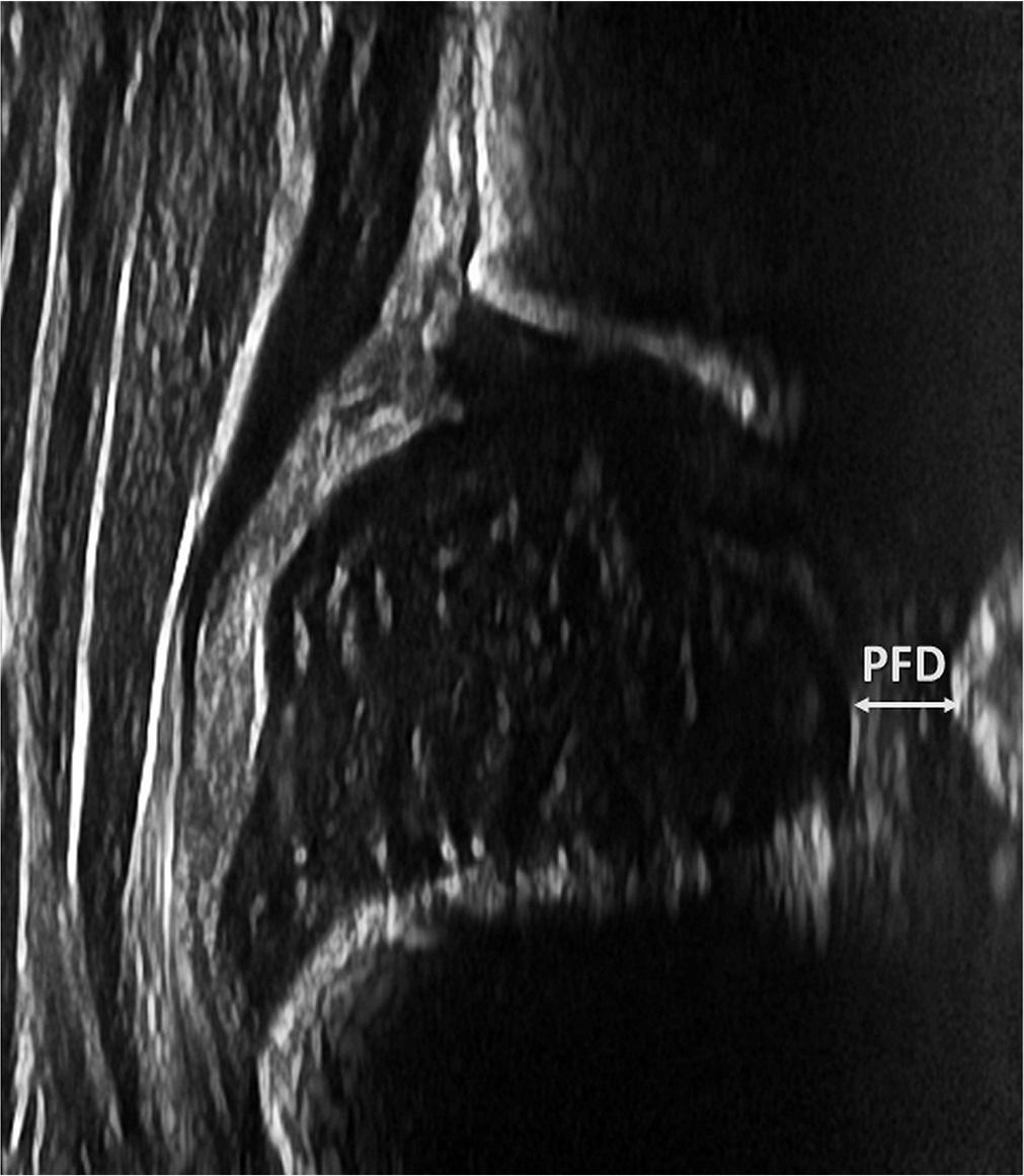 Measurement of the pubofemoral distance (PFD)