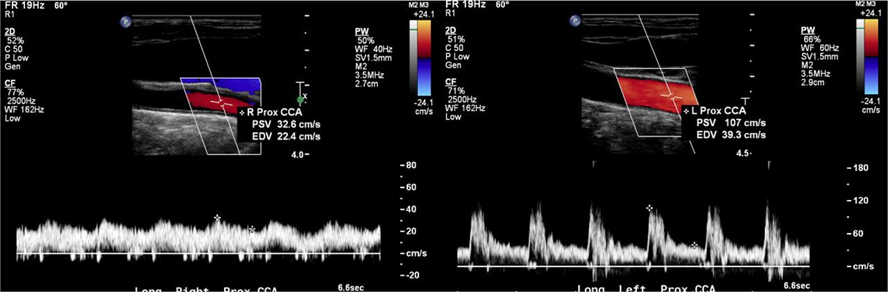 Comparison between the dampened waveform in the proximal RCCA and the normal waveform of the proximal LCCA