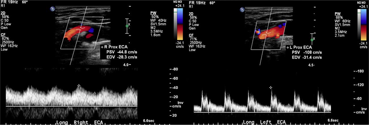 Dampened right external carotid artery (RECA) waveform with a PSV of 45 cm/s and end-diastolic velocity (EDV) of 28 cm/s compared to the high-resistance left external carotid artery (LECA) waveform