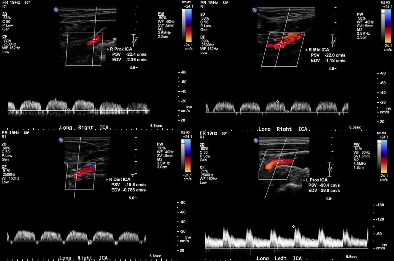 Evidence of transient end-diastolic flow reversal and dampening of the waveforms in the distal RICA. The PSV in the RICA does not exceed 23 cm/s in all segments. The proximal left internal carotid artery (LICA) waveform was added for comparison. When imaging the distal ICA, it is important to visualize the parotid gland and to follow the distal ICA, as it dives posteriorly. Increasing the color gain and decreasing the color pulse repetition frequency (PRF) may help visualize the distal ICA