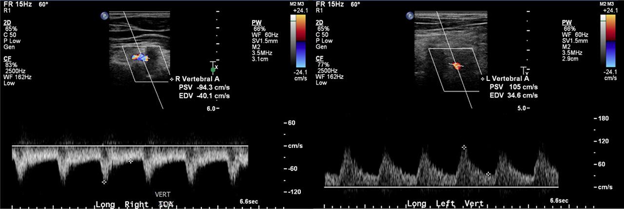 Retrograde flow noted in the right vertebral artery with a PSV of 94 cm/s and EDV of 40 cm/s. The left vertebral artery demonstrates antegrade flow with a PSV of 105 cm/s and EDV of 35 cm/s. When the direction of flow is not clear in the vertebral artery, it is advised to document the CCA in split screen, with red representing blood flow towards the brain, and then angling and sliding the probe laterally and posteriorly to image the vertebral artery without changing any of the Doppler parameters. The vertebral vein will be seen anterior to the vertebral artery and may appear pulsatile. It is important not to confuse the two vessels. Both will pass through the transverse foramina of the cervical spine, and it may be easier to distinguish the two by looking for the origin of the vertebral artery off the subclavian artery