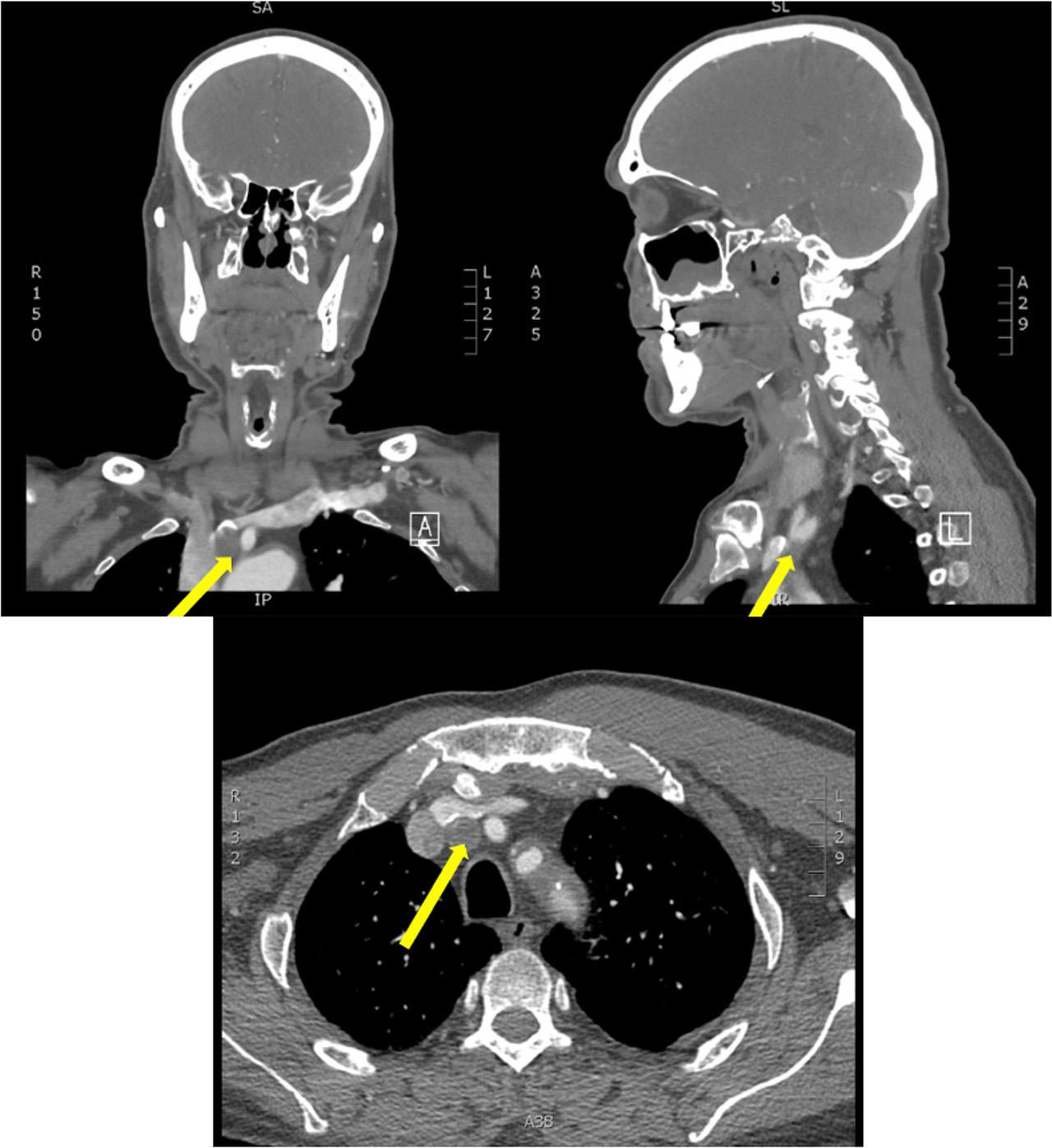 Occlusion of the innominate artery is demonstrated proximal to the origin of the RCCA and subclavian artery. Lack of enhancement in the innominate artery is demonstrated in all three planes