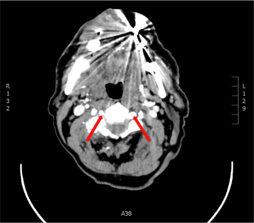 Evident left vertebral dominance alluding to contralateral compensatory flow