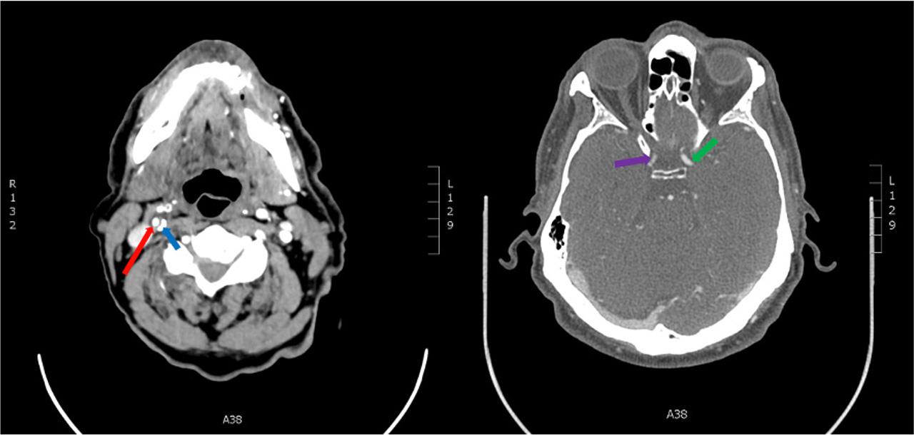 Moderate stenosis of the supraclinoid RICA is illustrated by the purple arrow, and calcified plaque (blue arrow) is demonstrated at the origin of the RICA (red arrow), causing a 30% diameter lumen reduction