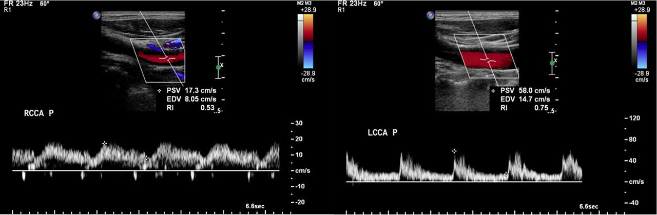 Tardus parvus waveform seen in the proximal RCCA