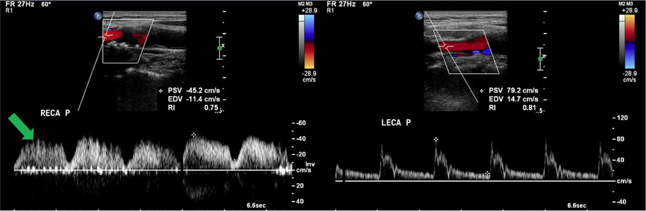 Rapid systolic upstroke with a sharp deceleration and diminished forward flow in diastole is characteristic of flow in the LECA. This is in contrast to the prolonged systolic acceleration and rounding of the systolic peak demonstrated in the RECA, consistent with a tardus parvus waveform. Temporal tap was applied on the right side to help distinguish between the RICA and RECA. Reflected waves indicated by the green arrow demonstrate a ‘saw-tooth’ pattern confirming the identification of the ECA