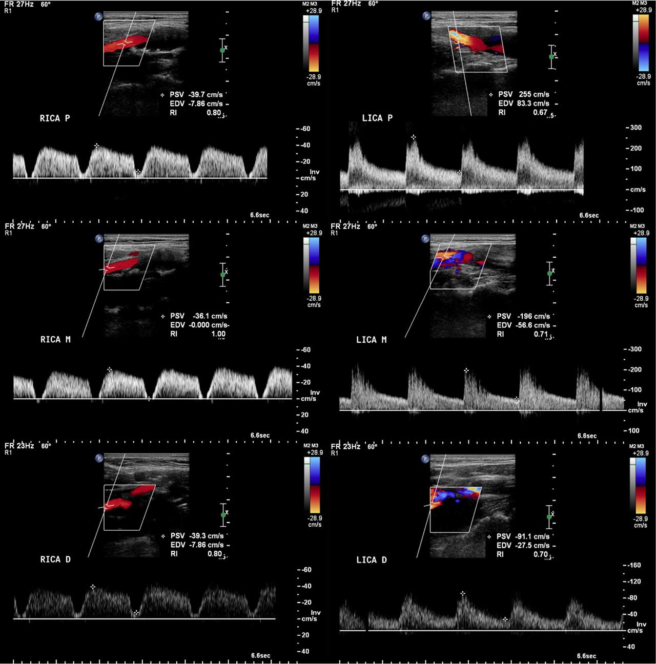 Tardus parvus waveform seen in the proximal RICA with spectral broadening. Diminished diastolic flow is seen in all segments of the RICA, signaling a change to high-resistance flow compared to the tardus parvus waveforms visualized in the RECA and RCCA. This may be caused by a moderate stenosis in the intracranial RICA. In the proximal LICA there is a PSV of 255 cm/s indicative of a 50–69% stenosis.