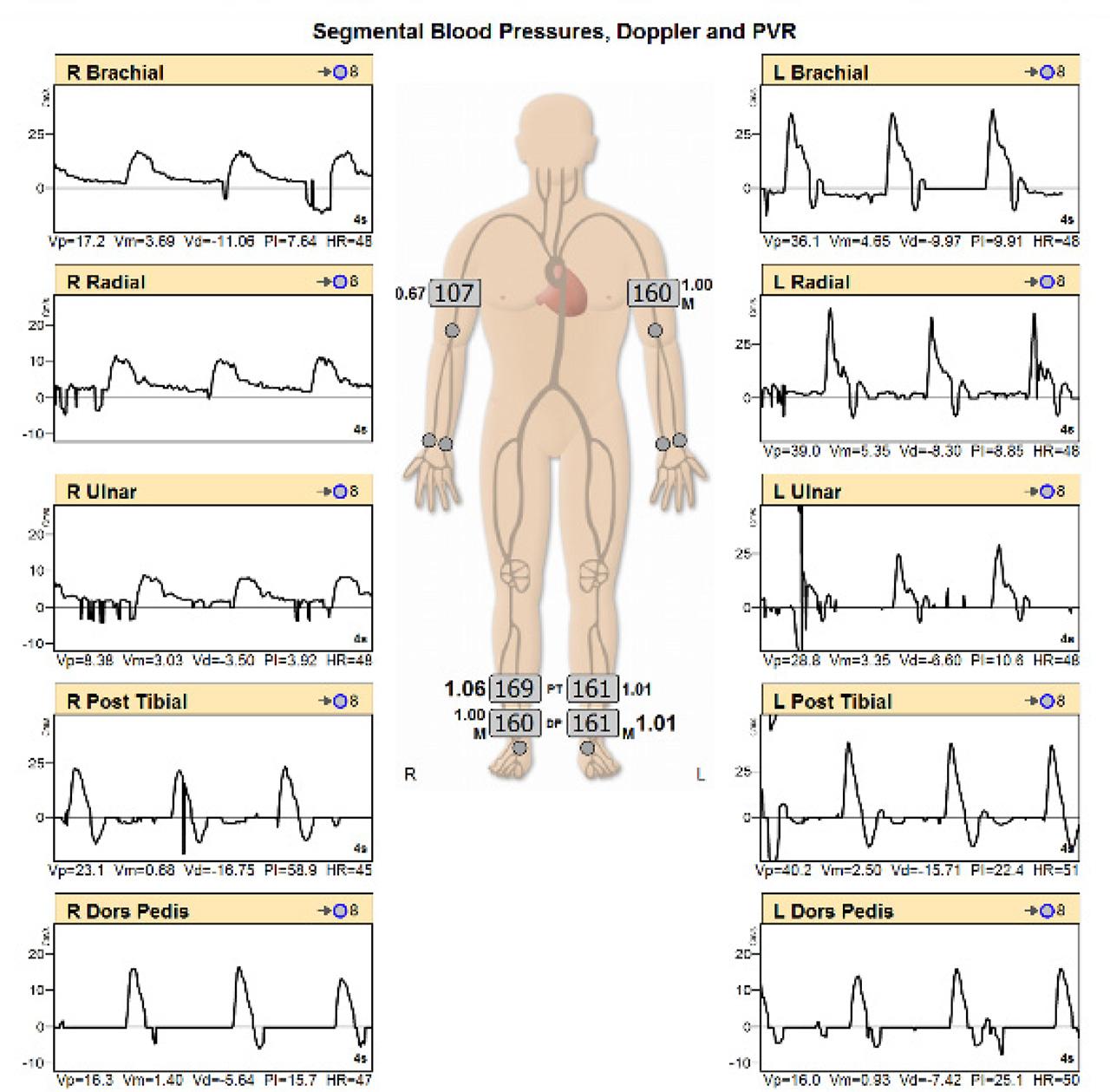 Right brachial, radial and ulnar artery waveforms display a rounded peak with a pronounced decrease in amplitude compared to the triphasic left upper extremity waveforms. The difference in brachial pressures across the arms, along with the CW Doppler findings, suggest moderate disease in the right arm. Ankle-brachial indices are in the normal range bilaterally, with multiphasic CW Doppler waveforms.