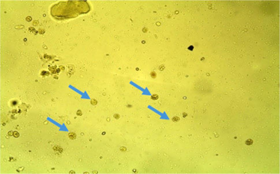 The Lugol’s iodine wet mount of a stool sample showed cystic stage of Entamoeba species (blue arrows) applying a light microscope at a magnification of 40×.