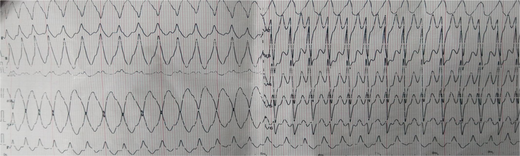 12-lead ECG – Wide complex QRS tachycardia, 180/min; RBBB morphology, right-axis deviation suggestive for anterolateral LV exit-site