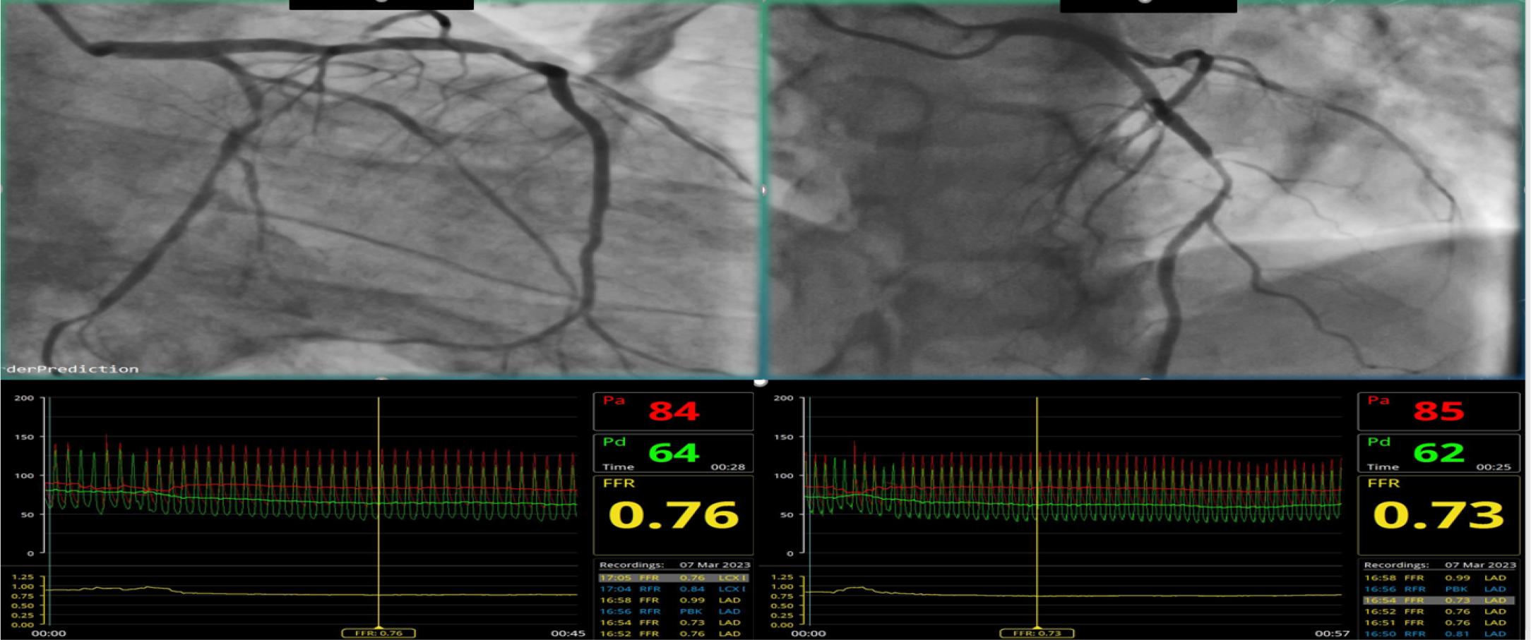 Coronary angiogram and FFR measurements – subocclusion of OM 1 (middle segment); 50 % middle LAD stenosis (FFR – 0.73); 50-60 % proximal LCx stenosis (FFR – 0.76)