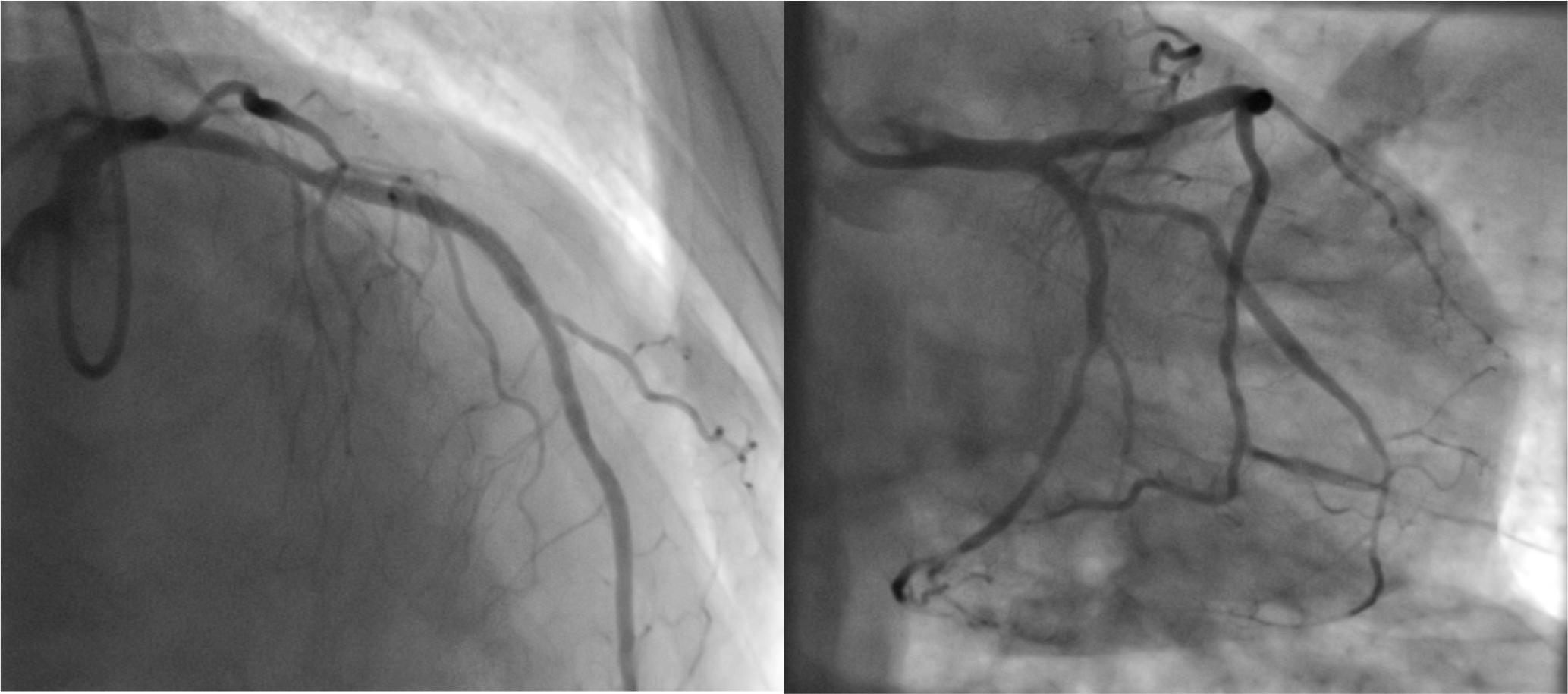 Coronary angiogram after implantation of 3 drug-elluting stents (middle LAD, proximal LCx and middle OM1)