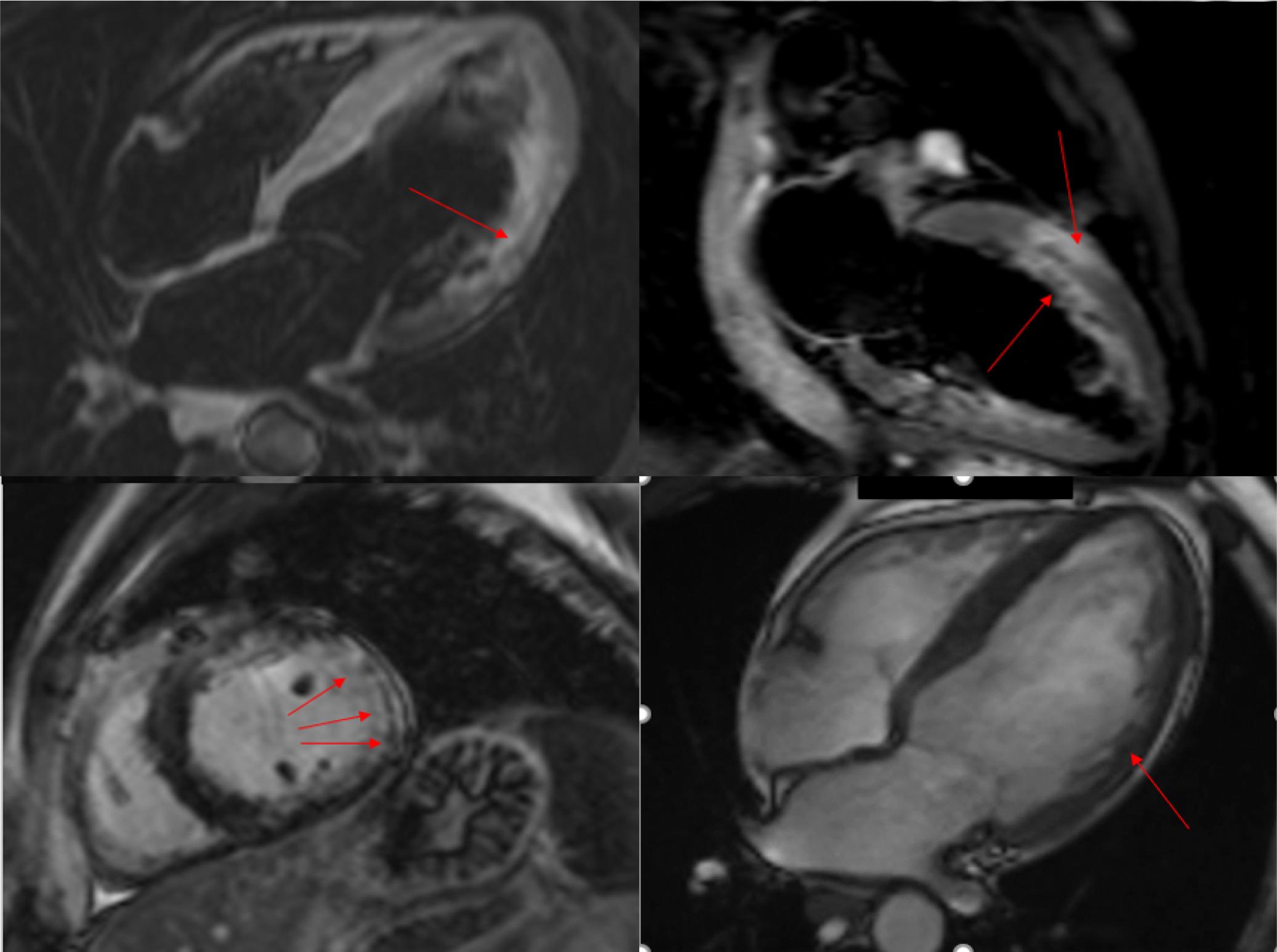 Cardiac MRI – Mild LV dilation; LVEF – 43 %; Multiple areas of LGE along the middle third of antero-lateral and lateral wall