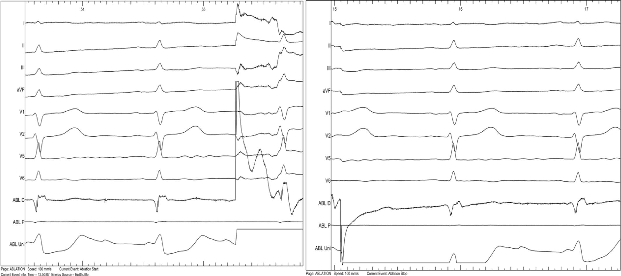 EGMs before and after RF ablation showing fragmented potential abolition at the conducting channel entry
