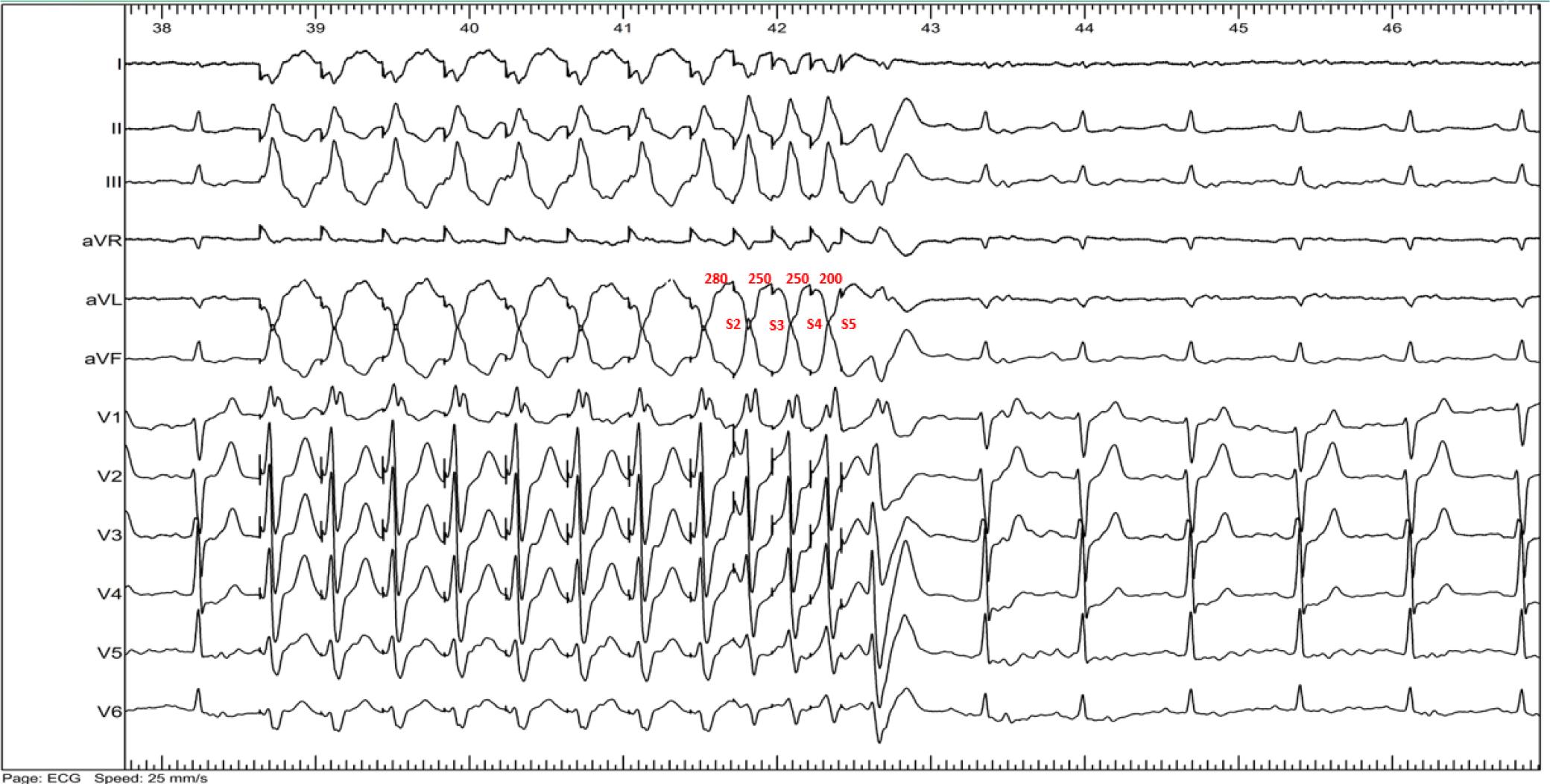 Ventricular programmed stimulation with 4 ES – complete non-inducibility of VT