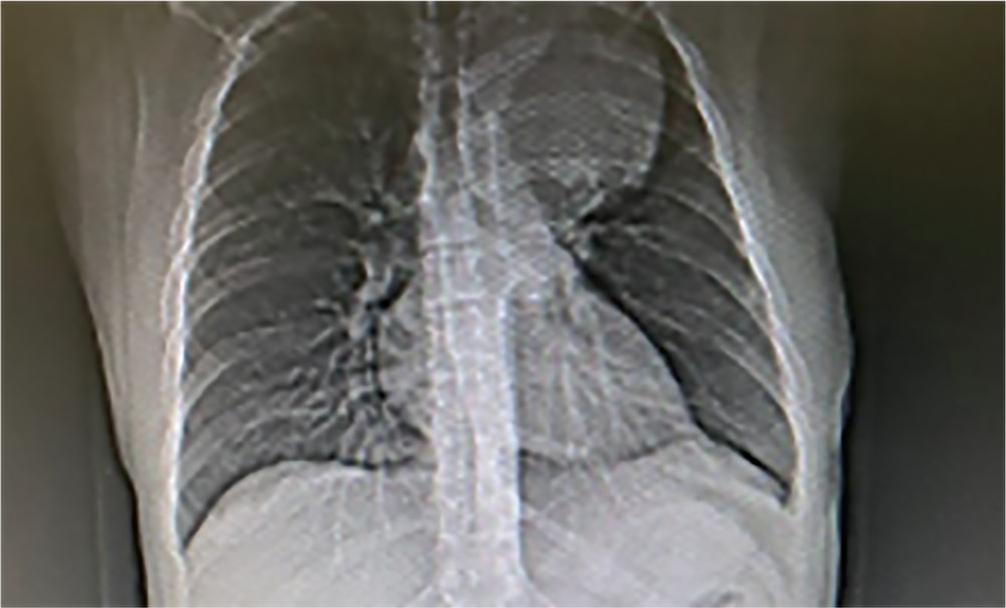 Chest X-ray. A paramediastinal left tumor, clearly contured, 120x80 mm.