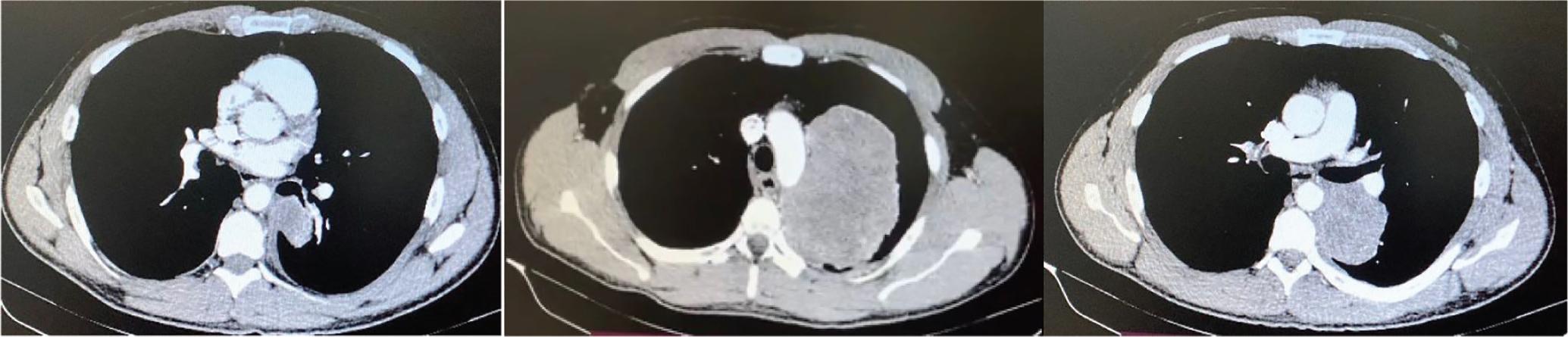 Chest CT scan. A large mass in the left upper lobe which did not have a plane of clivage from arch and descending aorta, as well as from left the pulmonary artery.
