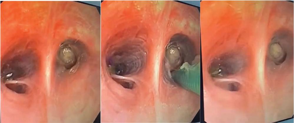Endobronchial aspect of the tumor.