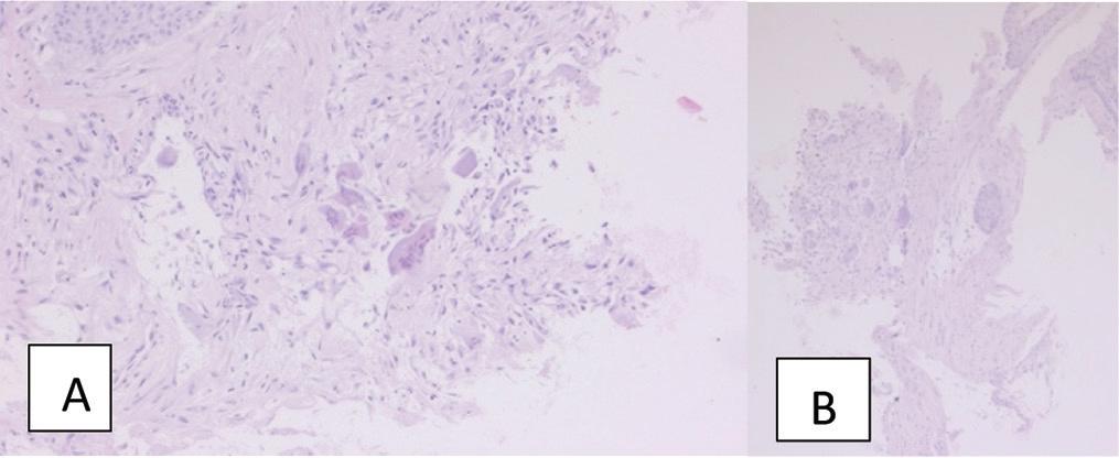 (A,B). Histological aspect of the tumor. A- HE 20x. B- HE 10x.