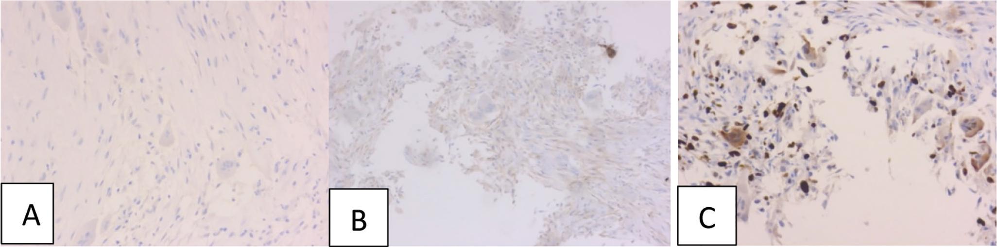 Immunochemistry (IHC). A. IHC S100 20x. B. IHC CD99 20x. C. IHC Ki67 20x.