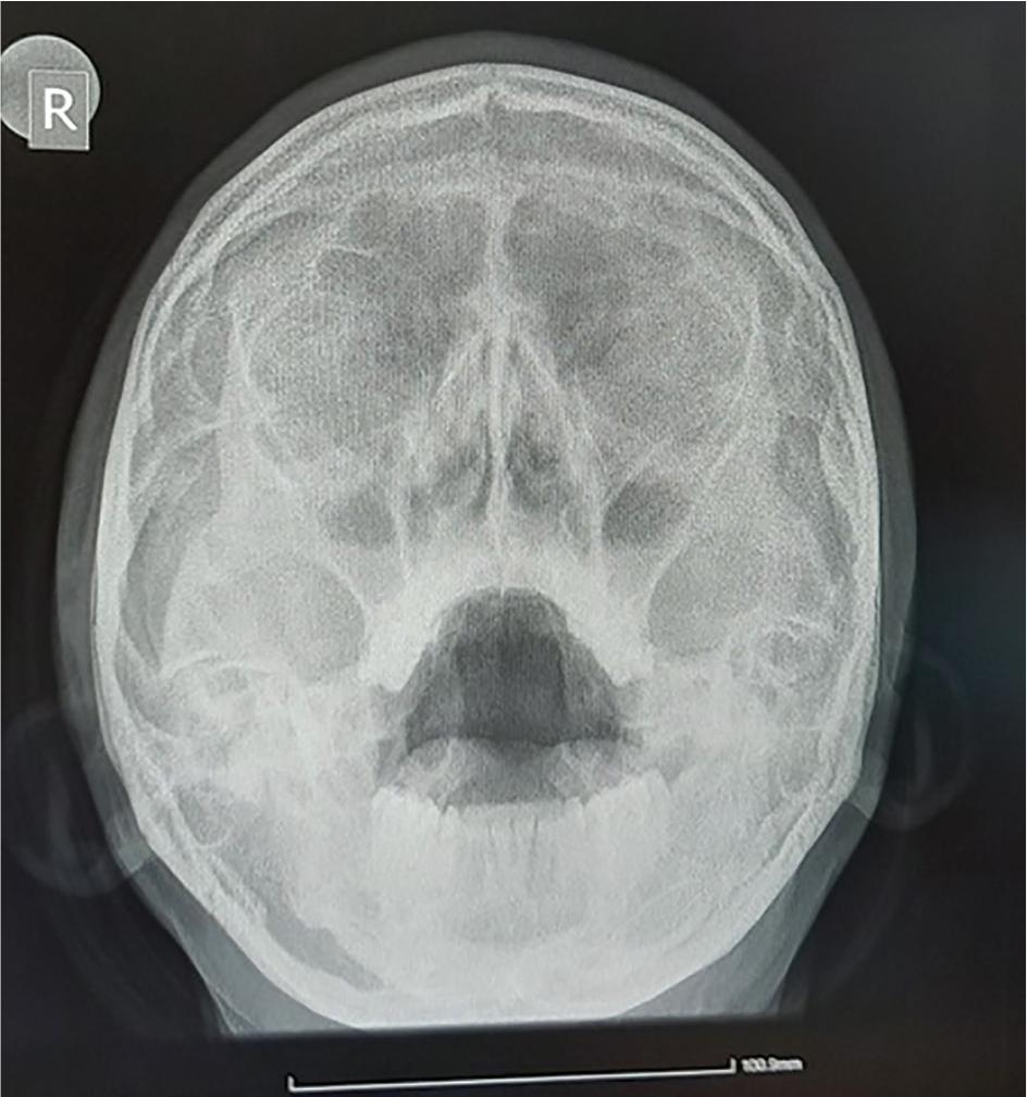 Sinus X-ray is documenting partially opacified maxillary sinuses.
