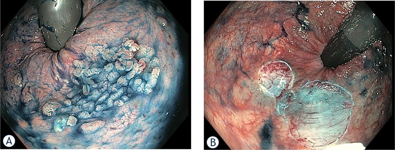 Surveillance endoscopy in a 48-year old patient with FAP after colectomy with IRA revealed 18 m LST-G (A). After submucosal injection with gelofusine, indigo carmine and adrenaline, piecemeal endoscopic mucosal resection (pEMR) (B) was performed.