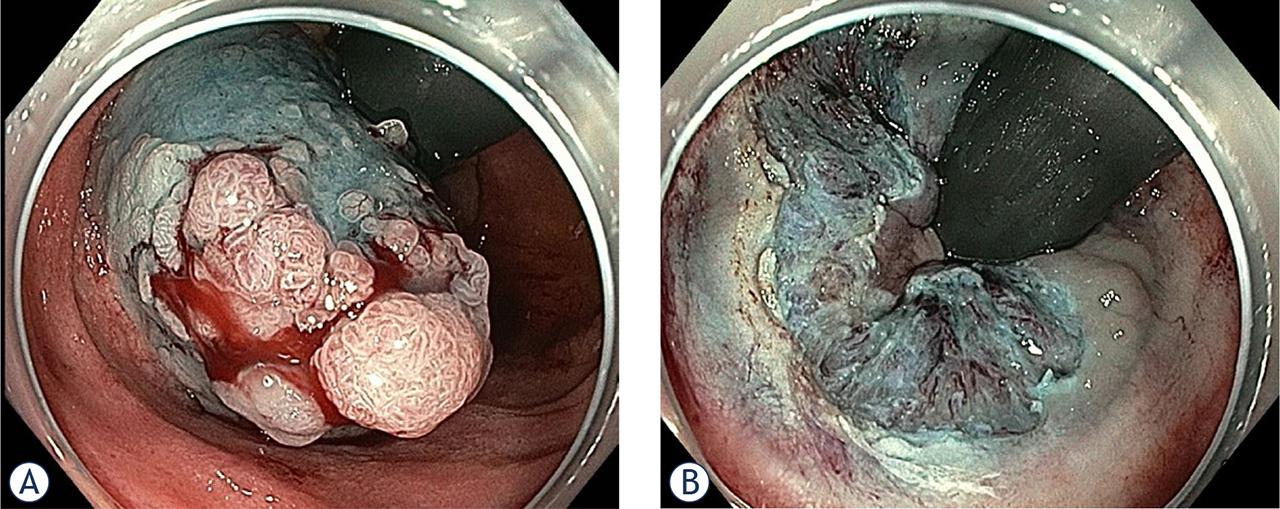 Surveillance endoscopy in a 49-year old patient with FAP after proctocolectomy with IPAA revealed 25 mm LST-G mixed type lesion in the rectal cuff. Lesion was spreading from the anastomosis to the dentate line. Patient had undergone surgery five years earlier and did not show up for endoscopy follow-up since then (A). Lesion was removed with pEMR (B).