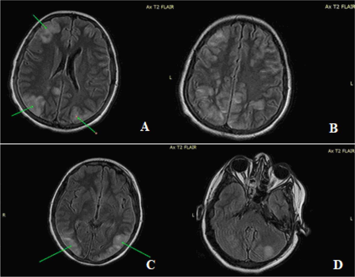 Multiple infra and supra centimeter lesions in hypersignal T2 and FLAIR diffusely arranged bihemispheric cortico-subcortical in (A, B) frontal and parietal lobes, (C) occipital lobe and (D) bihemispheric cerebellar
