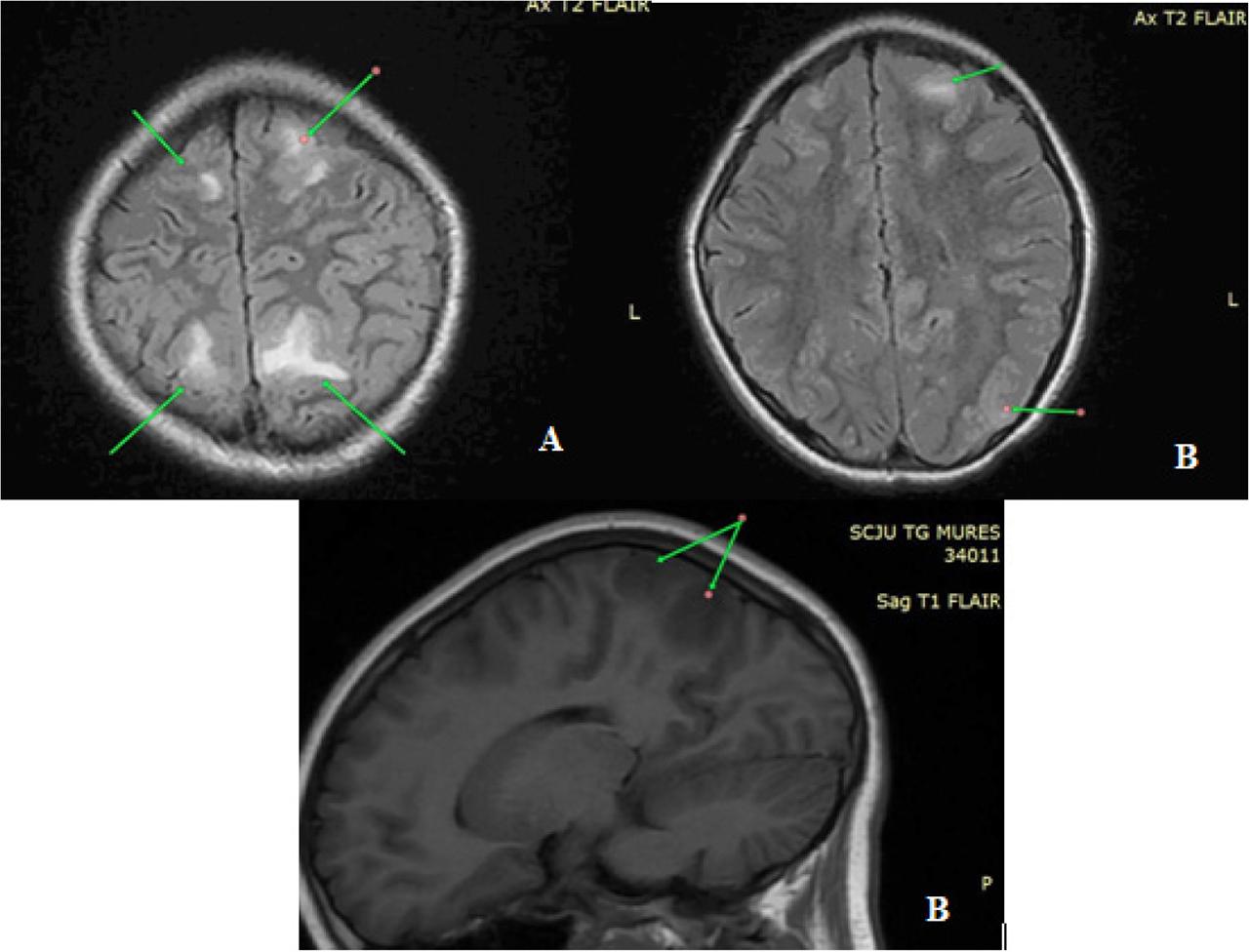 An inflammatory cerebral lesion showing hypersignal on T2 and FLAIR sequences, located at the level of the bilateral frontal lobe and post-central gyrus (A), respectively on the left parietal side (B)