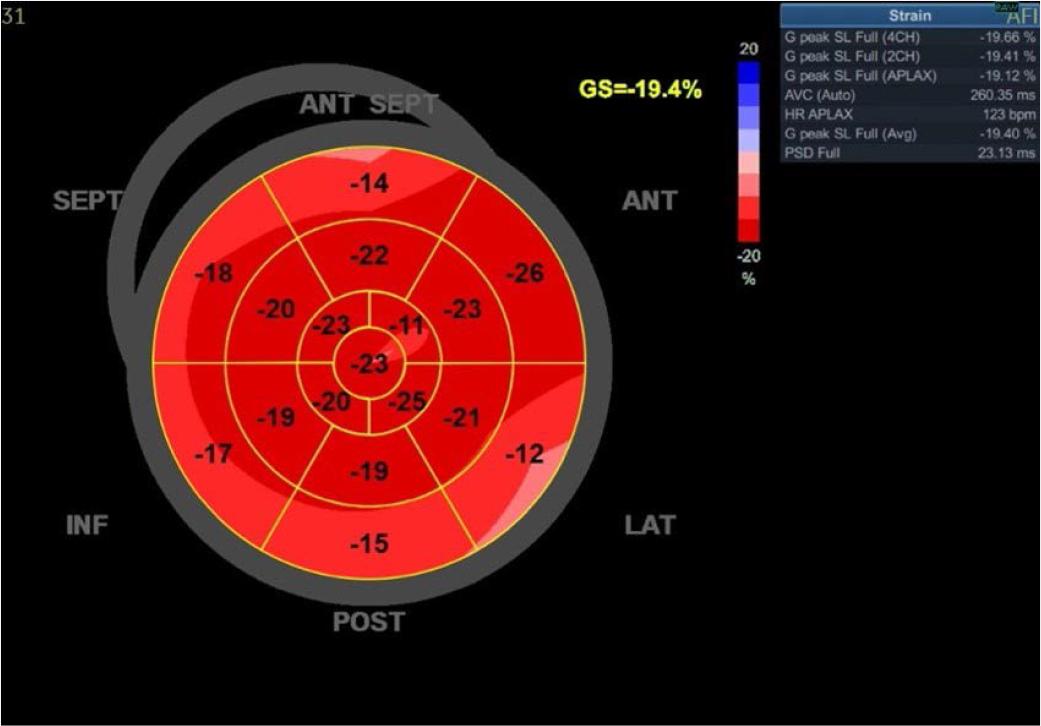 Echocardiography at admission, GS −19.4%