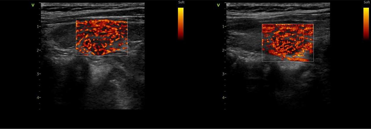 Vascularization of the left and right thyroid lobe