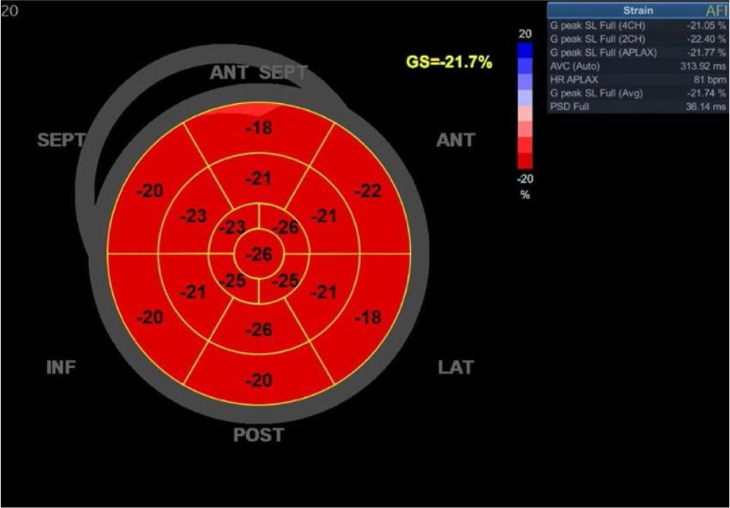 Echocardiography at discharge, GS −21.7%