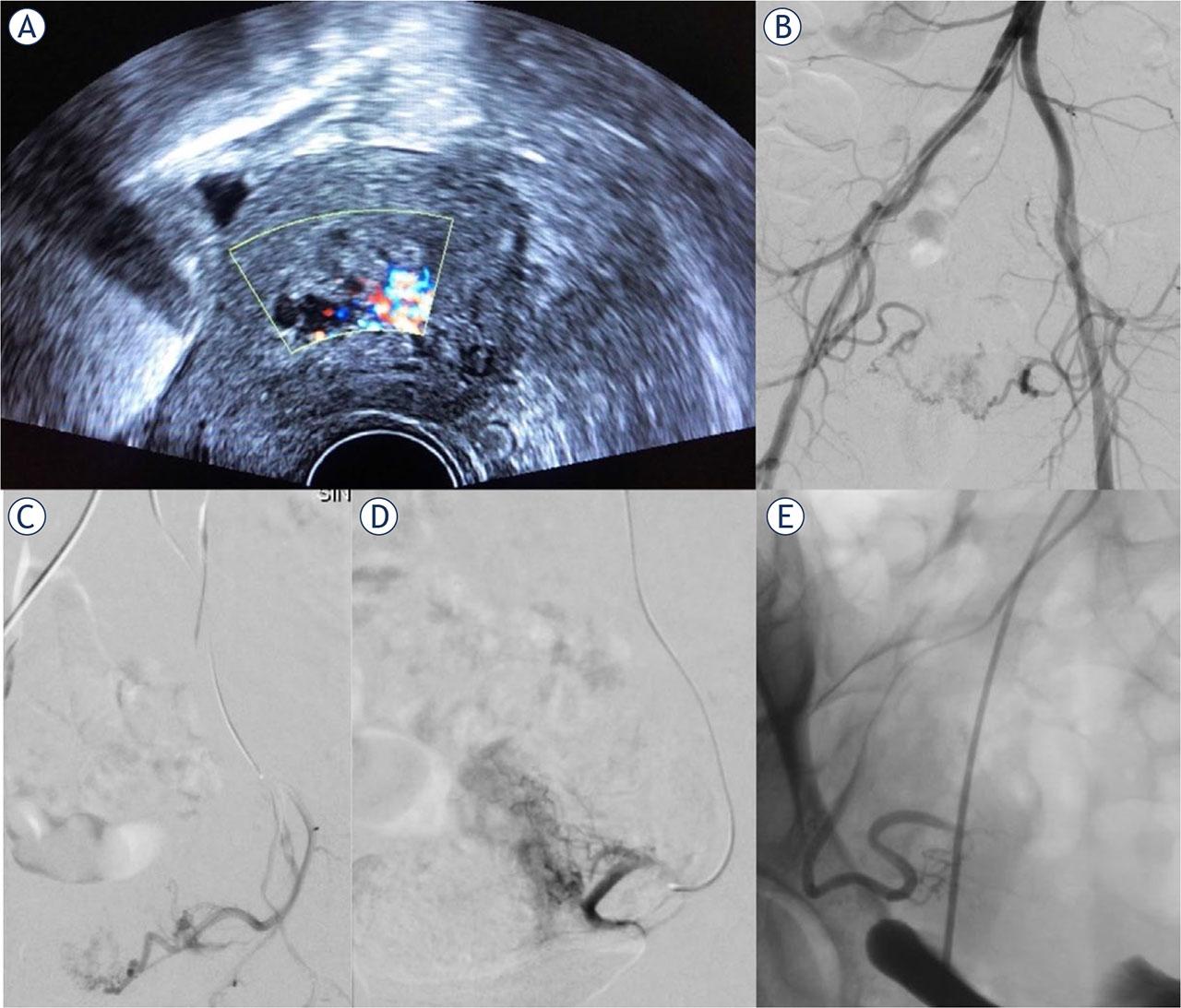 (A) Transvaginal ultrasonography in a 34-year-old female with vaginal bleeding after spontaneous termination of pregnancy at 12 weeks of gestation. Color Doppler ultrasound showed a 45 x 30 mm mass in the uterus with increased vascularity suggestive of retained products of conception. (B) Pelvic arteriogram demonstrating numerous spiral arteries in the uterus fed by both right and left uterine arteries, confirming the diagnosis of RPOC. (C) Left uterine arteriogram in the same patient before prophylactic embolization with absorbable gelatin sponge particles showing numerous spiral arteries. Postembolization left (D) and right (E) uterine arteriogram demonstrating successful embolization. Subsequently, surgical resection of retained products of conception was successfully performed.
