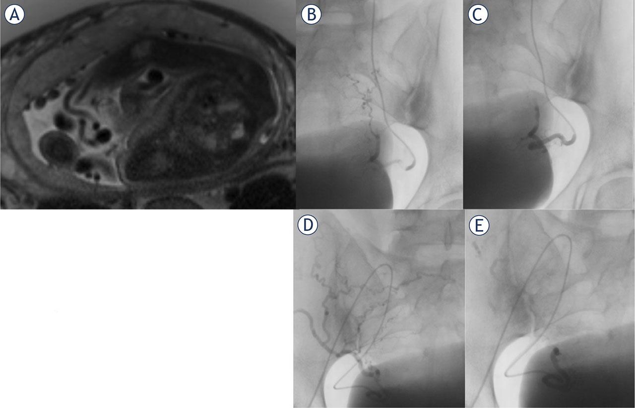(A) Abdominal magnetic resonance imaging in a 35-year-old woman with singleton pregnancy at the 33rd week of gestation with suspected placenta accrete. The placenta covers the whole anterior part of the uterine wall. On T2-weighted MR images, there is marked thinning of the myometrium at the placental-myometrial interface, with MRI signs of placenta accrete and placenta increta. On the left cranial part of the junction, there is suspected placental invasion through the entire uterine wall, suspicious for placenta percreta. (B-E) Selective uterine angiography and embolization following delivery in the same 35-year-old woman with placenta accrete. Left (B) and right (D) uterine angiogram confirming the diagnosis of RPOC with numerous voluminous spiral arteries before prophylactic embolization. Left (C) and right (E) post-embolization angiogram after successful selective uterine artery embolization with absorbable gelatin sponge particles to reduce vascularity prior to surgical removal. After embolization, the placental tissue was successfully resected, and hysterectomy was prevented.