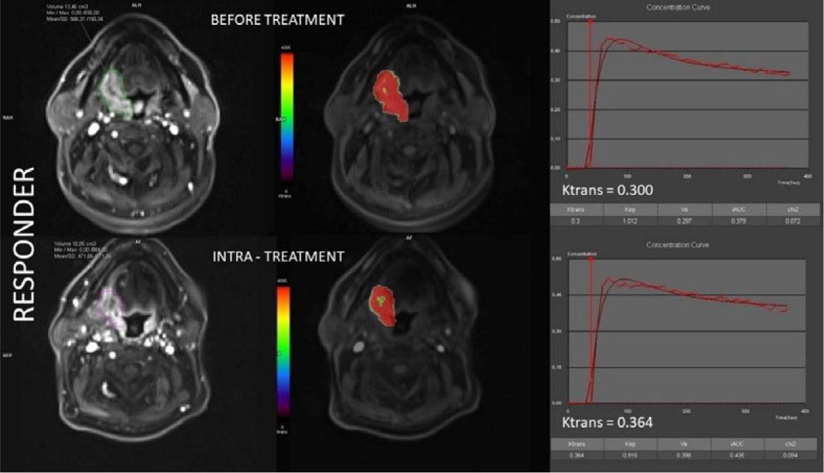 Co-registered volumes of interest (VOI) and color-coded ktrans maps, together with concentration curves alongside corresponding ktrans values before treatment (upper section) and intra-treatment after receiving 20 Gy radiotherapy (bottom section) in a representative responder patient.