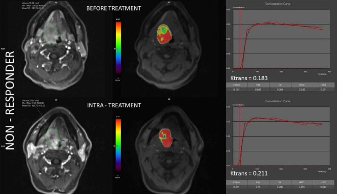 Co-registered volumes of interest (VOI) and color-coded ktrans maps, together with concentration curves alongside corresponding ktrans values before treatment (upper section) and intra-treatment after receiving 20 Gy radiotherapy (bottom section) in a representative non-responder patient.