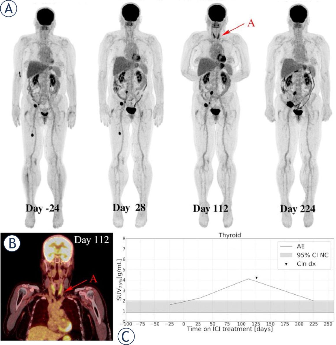 A 60-year-old female patient with metastatic BRAF V600E-mutated cutaneous melanoma, diagnosed in September 2021, was treated with pembrolizumab in the first-line setting. Serial 18F-FDG PET maximum intensity projections were obtained per protocol (A). The baseline 18F-FDG PET/CT image (day -24) showed metastatic disease present in soft tissue. Day 28 (W4) imaging study showed moderately increased colon uptake and heterogeneous response of all metastatic lesions. Patient had no symptoms of irColitis. Image at day 112 (W16) showed again a heterogeneous response of melanoma metastases and marked increase in 18F-FDG uptake in the thyroid gland (RED ARROW A), which can also be observed on coronal slice of the day 112 imaging study on fused 18F-FDG PET/CT (B). Patient was confirmed to have irThyroiditis on day 126, based on thyroid hormone laboratory test and examination of endocrinologist. Day 224 (W32) image showed decrease in 18F-FDG uptake in the thyroid gland and a clear progression of melanoma metastases. Systemic treatment was changed to targeted treatment with BRAF and MEK inhibitor. Moderate increase in 18F-FDG PET uptake in the thyroid gland was seen already on W4 18F-FDG PET, 98 days before clinical detected (C).AE = adverse events(irAE