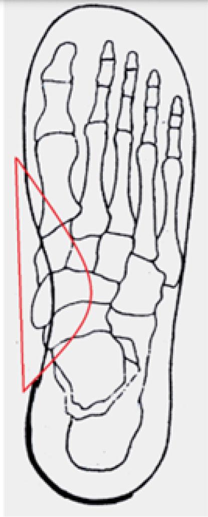 Longitudinal arch support. Source: RAJCHEL-CHYLA, B., GAJEWSKI, R. Selected corrective elements and their use in making orthotics for children and adults (in polish). Lecture at the Orthopaedic Footwear and Insoles Conference(in polish). Kraków, 2006.06.09. ISBN 83-922656-1-0. (with own modifications)