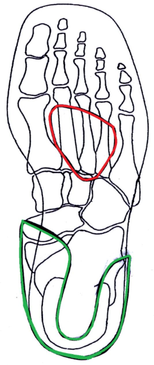 Metatarsal support (red), footbed (green) – (source: own research)