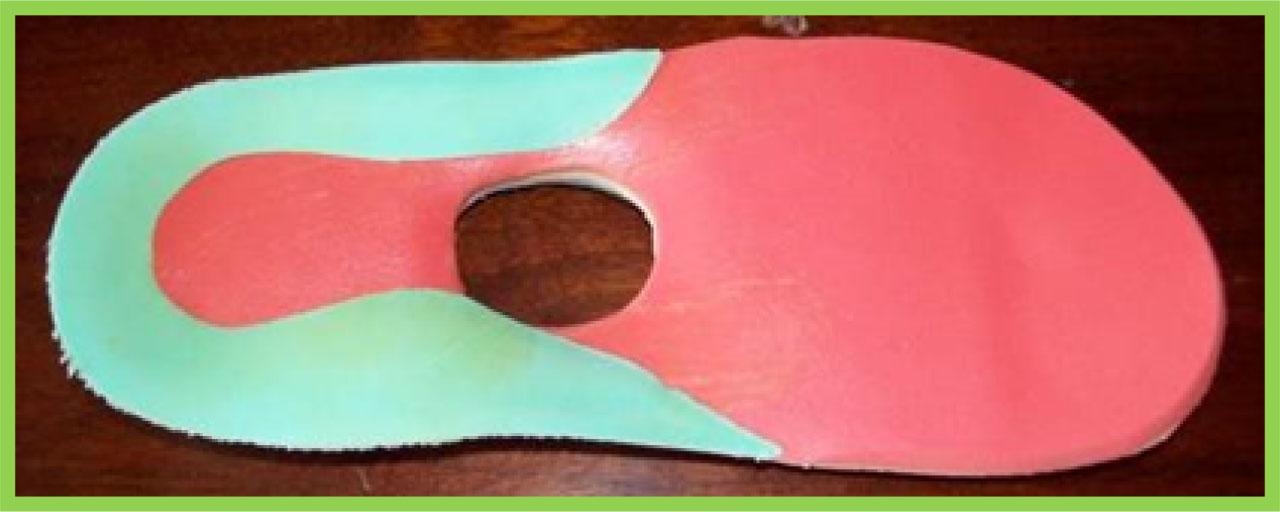 An insole individually adapted to a patient with a foot at risk of ulcer formation, made by gluing several layers of foam material together. A hole is provided in the area of high pressure (source: own research)