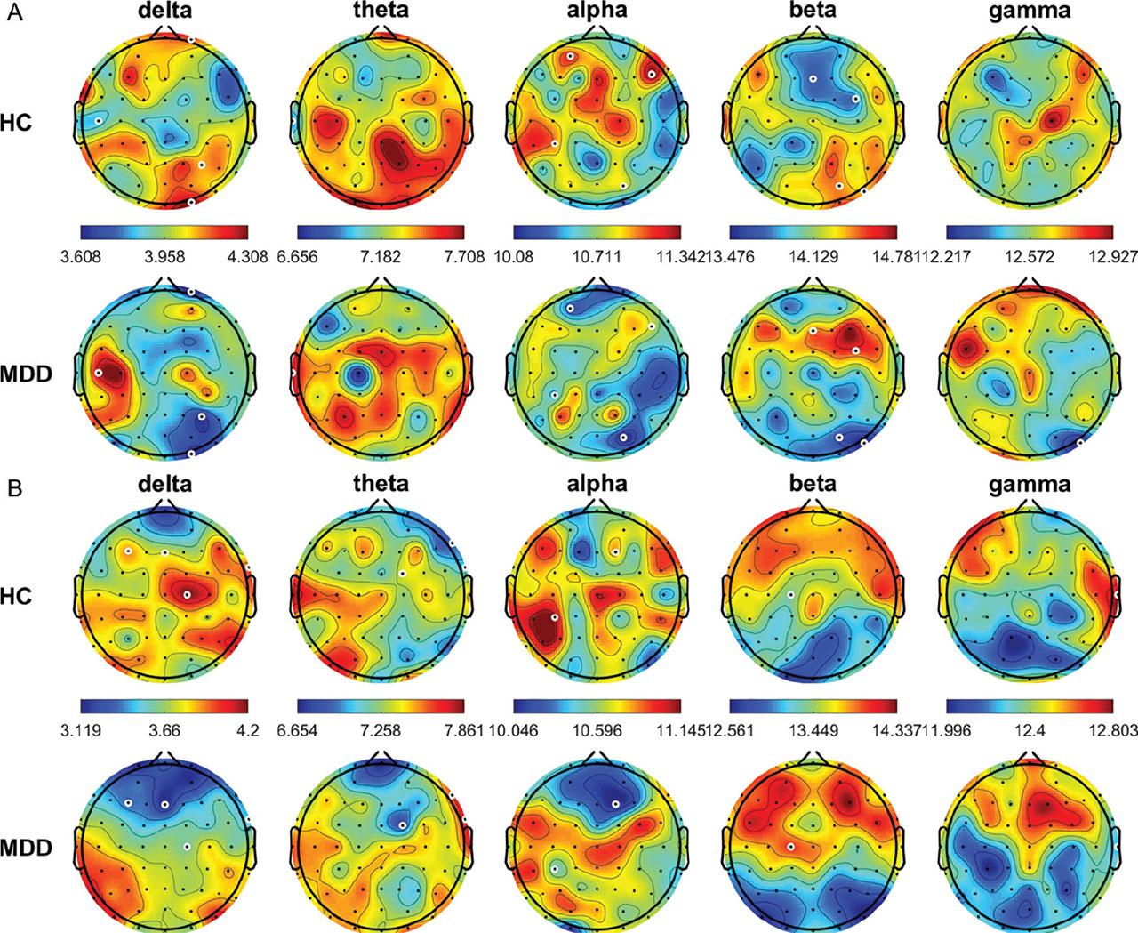 Average MSE for the different frequency bands from all HCs and patients with MDD in the OE (A) and CE (B) conditions. White circles denote significant between-group differences (P < 0.05). CE, eyes-closed; HCs, healthy controls; MDD, major depressive disorder; MSE, multiscale entropy; OE, eyes-open.