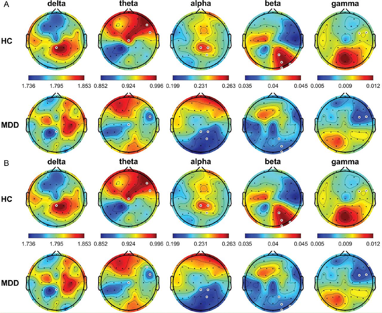 Average DFA for the different frequency bands from all HCs and patients with MDD in the OE (A) and CE (B) conditions. White circles denote significant differences between groups (P < 0.05). CE, eyes-closed; DFA, detrended fluctuation analysis; HCs, healthy controls; MDD, major depressive disorder; OE, eyes-open.