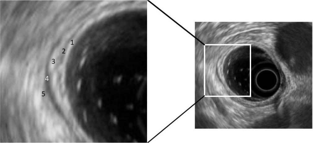 Oesophagus, EUS scan. Radial probe with balloon filled with water. 1. Mucosa, 2. Muscularis mucosae, 3. Submucosa, 4. Muscularis propria, 5. Adventitia. Courtesy of dr. Abdulhabib Annabhani from the Department and Clinic of Gastroenterology and Hepatology, Wroclaw Medical University