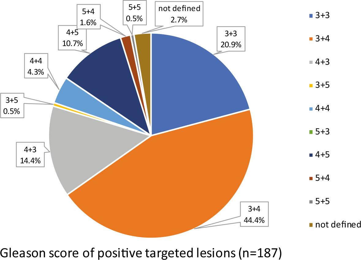Gleason score of all positive biopsy (BX) lesions. Category »not defined« includes lesions with suspect cores for carcinoma, undefined Gleason score in invasive carcinoma and atypical small acinar proliferation (ASAP).