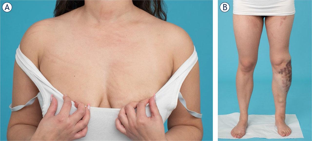 After Bleomycin ElectroScleroTherapy (BEST) flagellate dermatitis can occur on the sites of skin. (A) Scratching can cause permanent hyperpigmentation due to bleomycin. (B) Marks of the electrode insertion are visible at the site of the treatment.