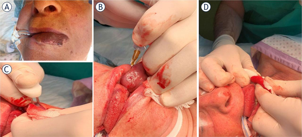 Procedure of Bleomycin ElectroScleroTherapy (BEST) in the treatment of low-flow vascular malformation on the lip. (A) Patient pre-treatment. (B) After the injection of bleomycin solution, the (C) electric pulses were applied on several areas with the finger electrode, avoiding overlap of the electric field. Procedure was completed in 10 minutes. The treated malformation was compressed (D) for several minutes to stop bleeding. Due to the vascular effects of BEST, the bleeding stopped spontaneously.