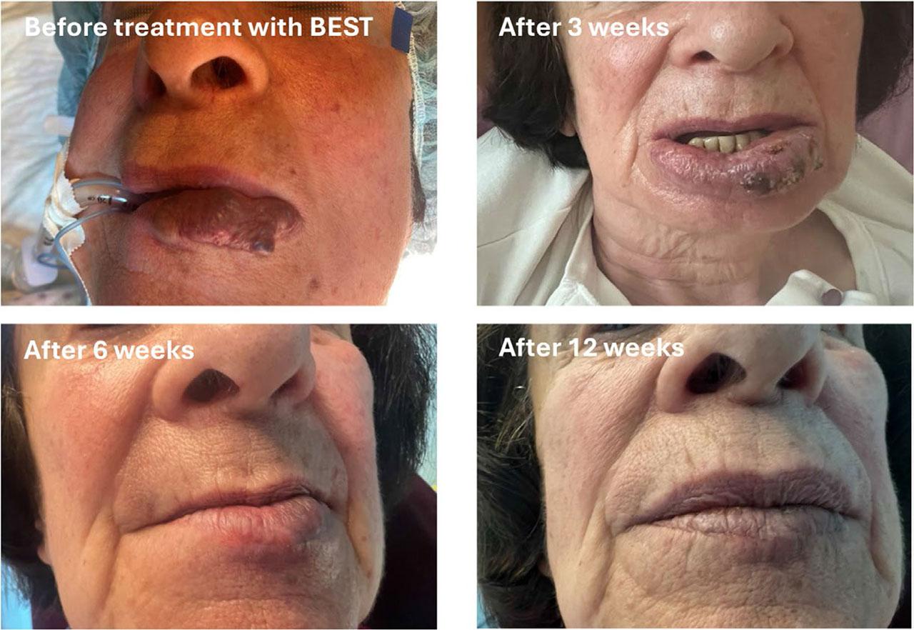 Example of Bleomycin ElectroScleroTherapy (BEST) treatment effectiveness on low-flow vascular malformation. After treatment, the treated area is oedematous, with a scab over the treated area after 3 weeks. The scab falls off in about 6 weeks with already visible treatment effectiveness. After 3 months, an excellent effect is visible after one treatment only.