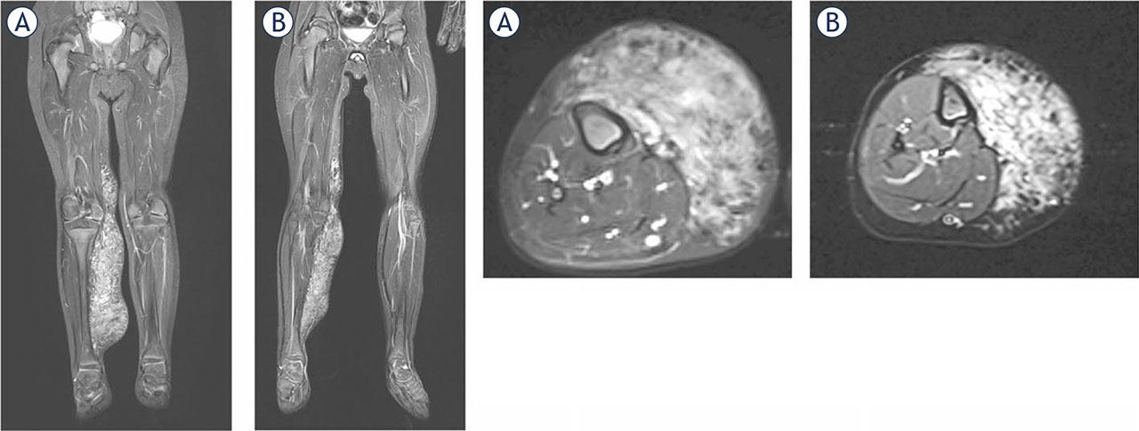 Microcystic lymphatic malformation before Bleomycin ElectroScleroTherapy (BEST) (A) and one year after (B). A significant reduction of the malformation is observed.